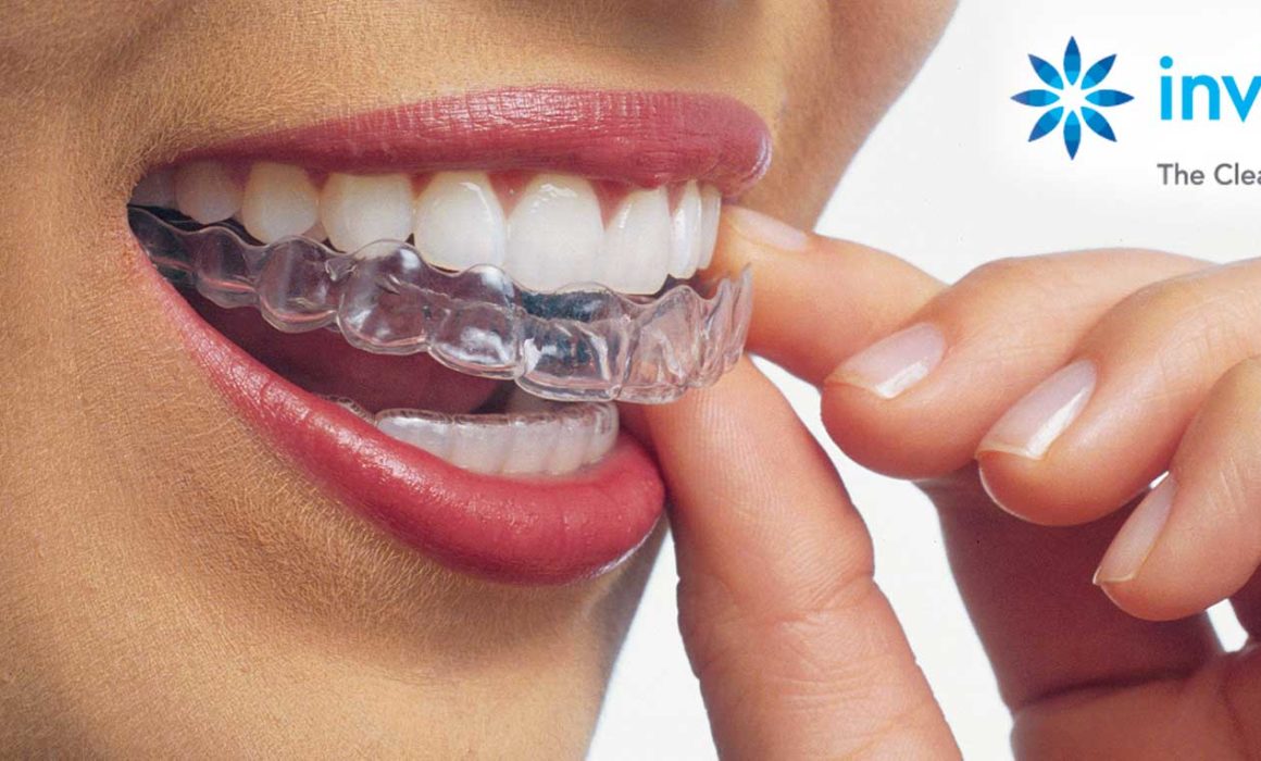 Soluzione invisalign presso lo studio dentistico barbara sarti